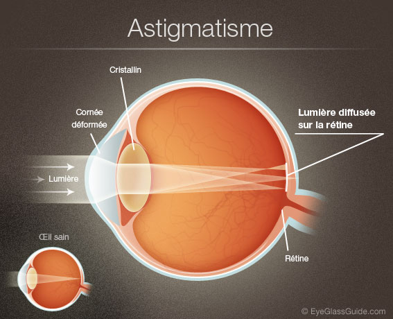 What Is A Normal Astigmatism Number