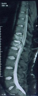 images/Spinetrauma3