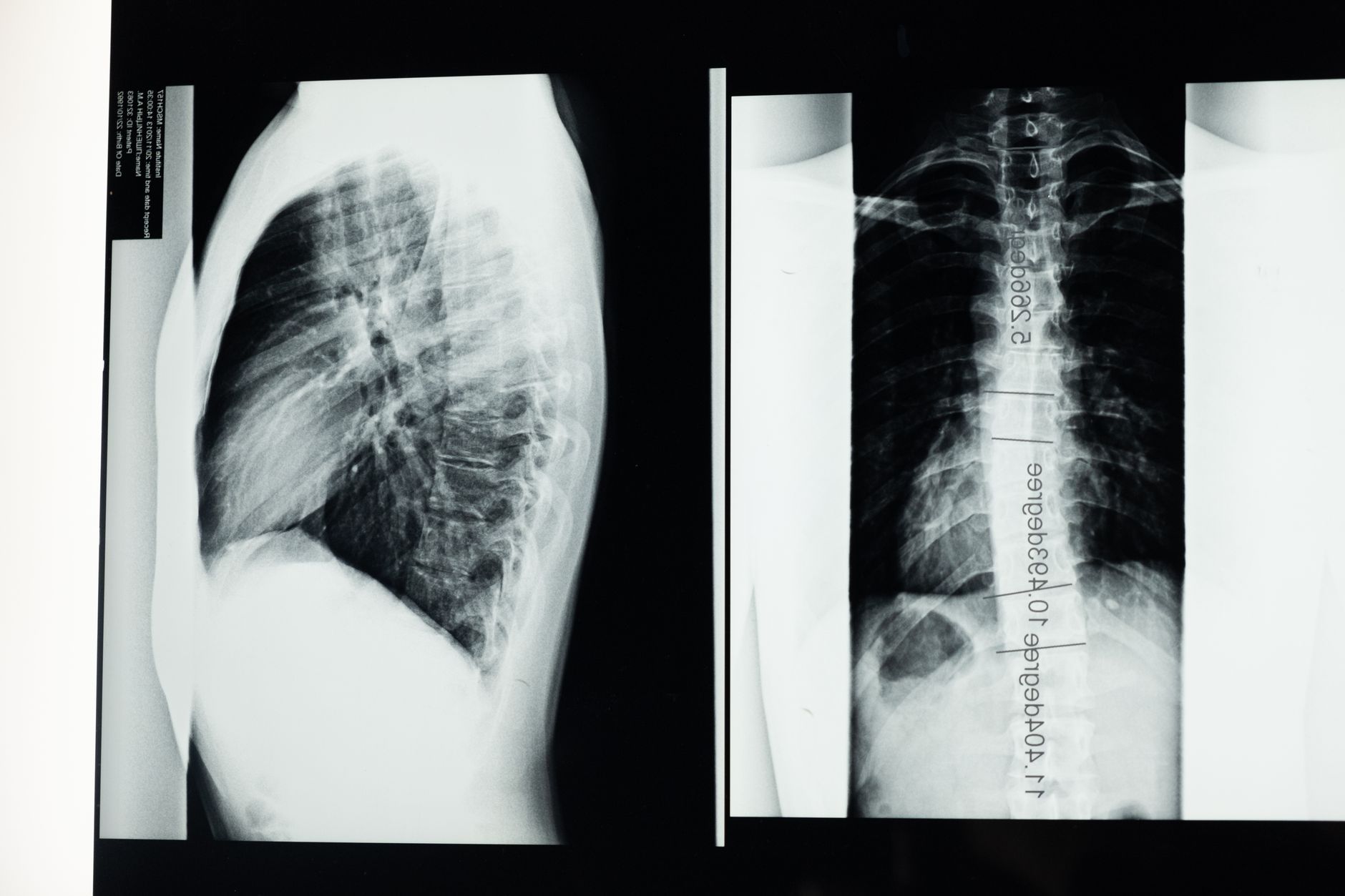 x ray images of the spine